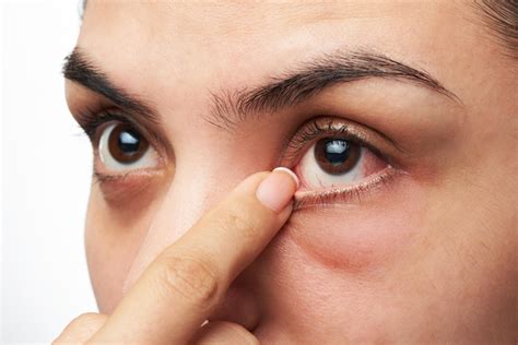 Red Watery Dry Itchy Eyes And Eyelids Causes And Cures American Celiac