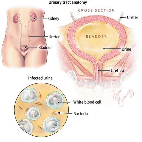 Urinary Tract Infections In Older Women Geriatrics Jama The Jama Network