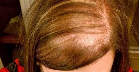 Hair loss treatments for women that work. Alopecia difusa, causas y tratamientos