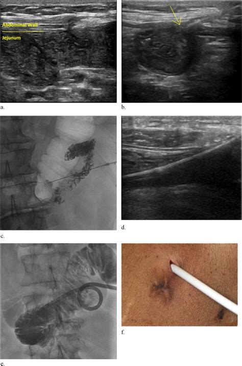 Percutaneous Jejunostomy Repeat Access At The Healed Site Of Prior