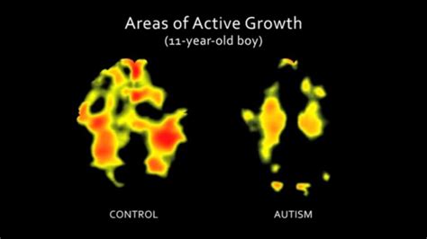 Autistic Brains Develop Slowly During Childhood