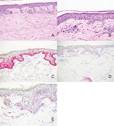 Prame Expression In Mimickers Of Melanoma In Situ Pagets Disease