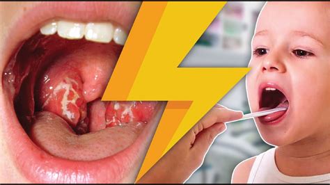 Tosils Symptoms And Causes Of Tonsillitis In Children And Adults