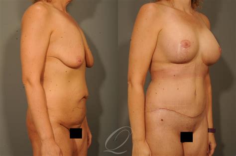 Mommy Makeover Before After Photos Patient 314 Serving Rochester