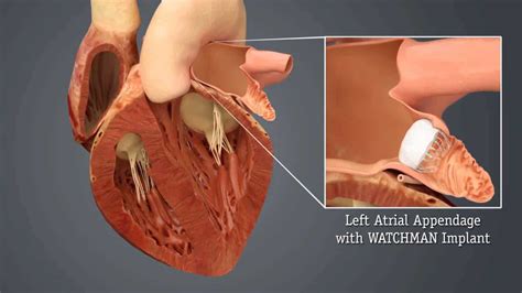 Left Atrial Appendage Occlusion Laao Stroke Manual