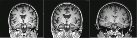 5 Mri Findings At Baseline And 2 Year Follow Up In Typical Alzheimers
