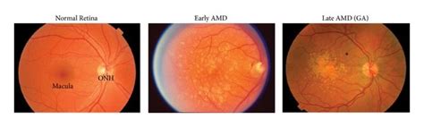 Clinical Stages And Signs Of Age Related Macular Degeneration A