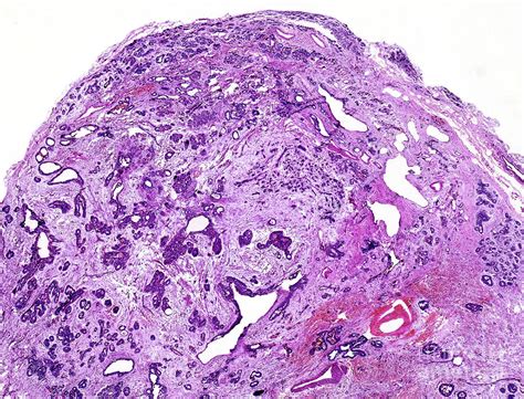 Fibrocystic Disease Of The Breast Photograph By Nigel Downerscience
