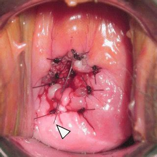 114 patients were treated with conization with the application of sturmdorf sutures. Post-cervical dilation surgery insertion of the ...