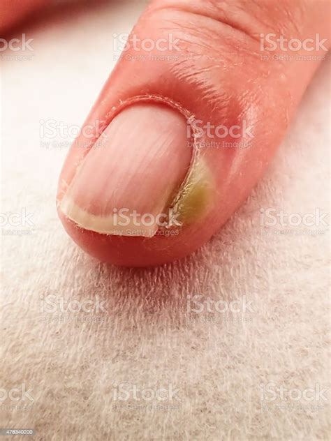Paronychia Infection Of A Finger Stock Photo Download Image Now Istock