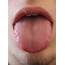 Burning Tongue 9 Causes One Life Threatening » Scary Symptoms