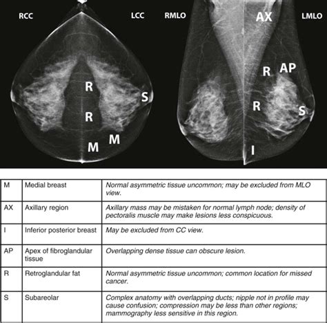 Screening Mammography 101 And Beyond Radiology Key