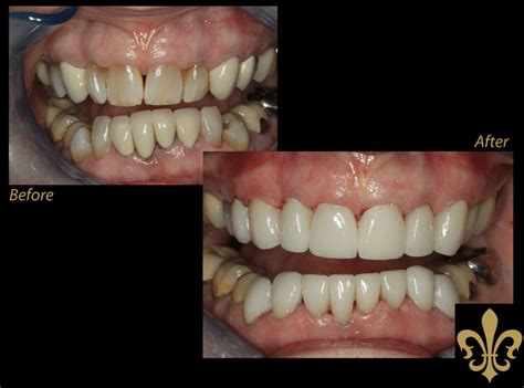 In addition to dental insurance, consumers can choose from full coverage and supplemental plans. See some of our before and after images of REAL patients!