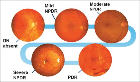 Diabetic patients were randomly identified from a national registry of diabetic patients, representing severity levels of dr and dme were defined according to the international clinical classification of for patients with no retinopathy, screening every 2 years may be appropriate while those with mild. Visual Reality: Diabetic Retinopathy - Use of ...