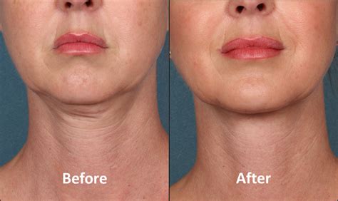 Kybella Center For Cosmetic And Clinical Dermatology