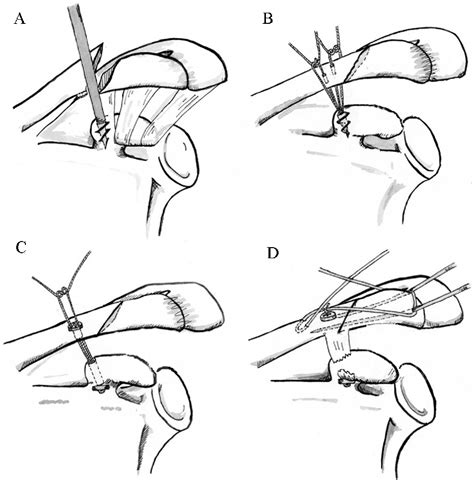 Modified Tension Band Fixation And Coracoclavicular Stabilisation For