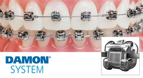 Sistema De Brackets Damon En Ortodoncia Ortodental Ortodoncista En