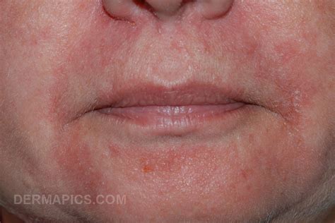 Perioral Dermatitis Pictures And Clinical Information From The