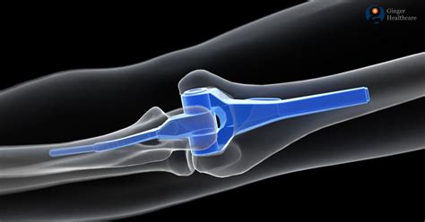 Elbow Replacement When Needed Procedure Explained Implant Types