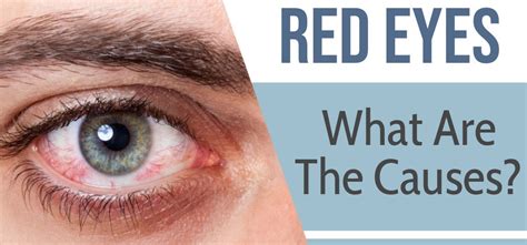 Red Eyes What Are The Causes