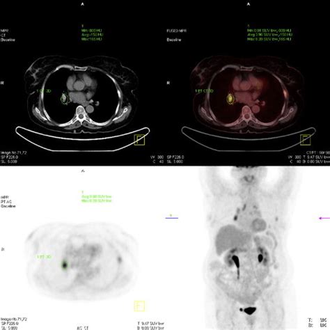 A Fdg Petct Scan Demonstrated High Grade Metabolic Activity In The