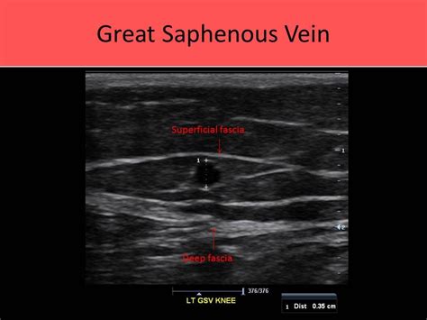 Extremity Venous Ultrasound Diagnostic Medical Sonography Medical Ultrasound