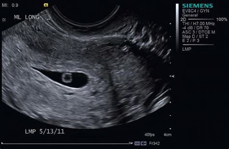 First Trimester Pregnancy Radiology Key