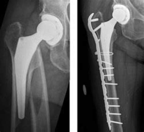 Fracture After Total Hip Replacement Orthoinfo Aaos