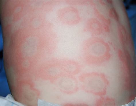Baby Rash Pictures Causes Treatments Allergic Reaction Rash
