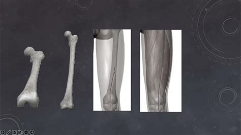 Surgical Approaches For Distal Femur Fractures And Swashbuckler Approach