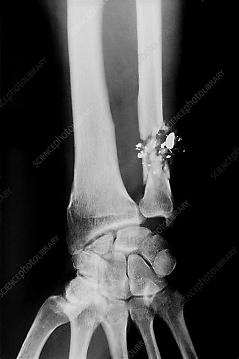 Fractured Wrist X Ray Stock Image M3301354 Science Photo Library