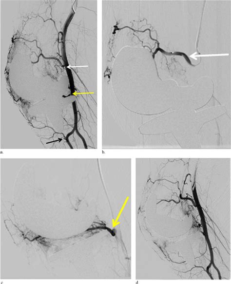 Geniculate Artery Embolization For Management Of Recurrent Hemarthrosis A Single Center