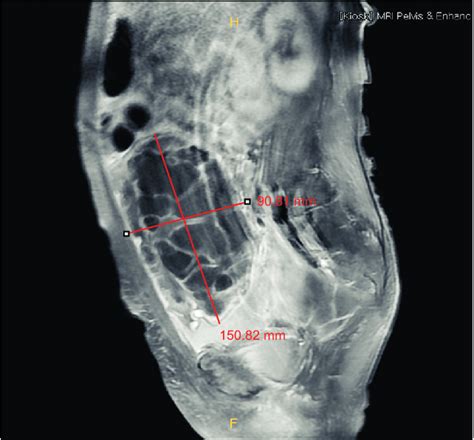 About 15 X 9 Cm Sized Large Multiloculated Cystic Mass With Ascites