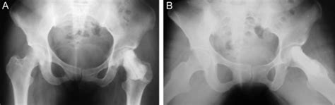 Radiografia Em Anteroposterior A E Em Perfil De Lowenstein B Da
