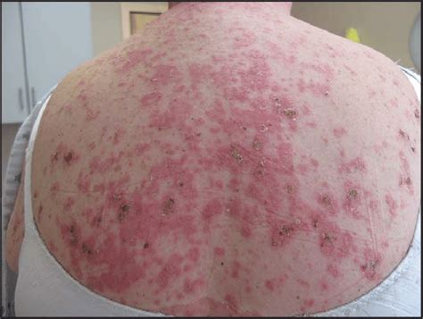 Papulosquamous Subacute Cutaneous Lupus Erythematosus Scaly