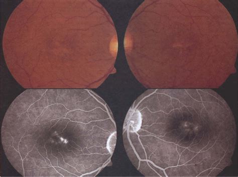 Upper Left Yellowish Flecks At The Level Of The Retinal Pigment