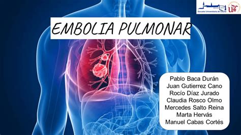 Embolia Pulmonar Cuidados Cr Ticos Y Paliativos Youtube
