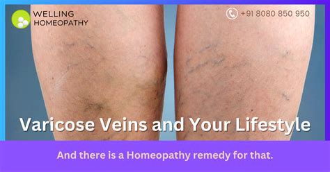 The Surprising Link Between Varicose Veins And Your Lifestyle