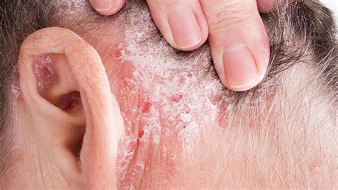 Cómo Tratar La Psoriasis En Casa Consulta De Dermatología Dermitek