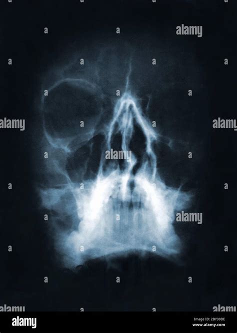 Skull X Ray Image Stock Photo Alamy