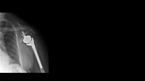 Film X Ray Shoulder Show Shoulder Joint Prosthesis The Patient Has
