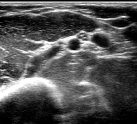 Arm Dvt Normal Ultrasoundpaedia