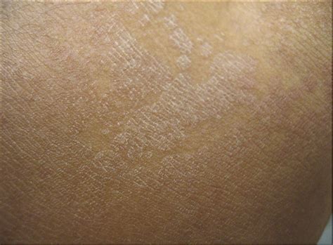 Evoked Scale Sign Of Tinea Versicolor Dermatology Jama Dermatology