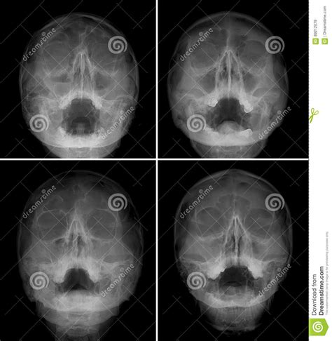 Sinusitis At Frontal Ethmoid Maxillary Sinus Film X Ray Of Skull And Blank Area At Right