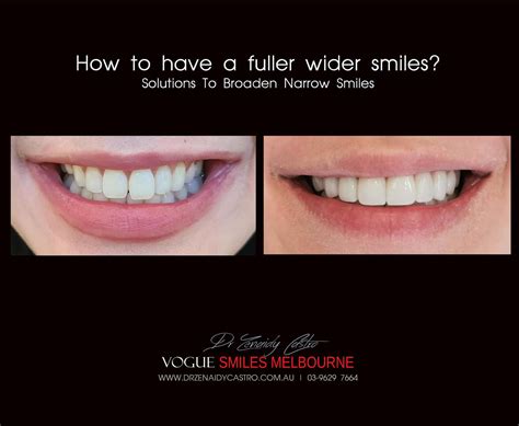 Gum Lifts And Contouring Reduce Gummy Smiles Melbourne