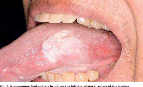 Oral Leukoplakia And Proliferative Verrucous Leukoplakia A Review For