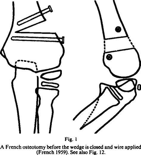 Figure 6 From Supracondylar Osteotomy Of The Humerus For Correction Of