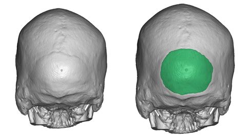 Occipital Skull Reduction Planning Back View Dr Barry Eppley