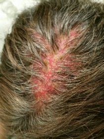 You may lose some hair due to skin peeling and itching, but these will likely regrow. The Pirate Empire: Sunburned Pirates