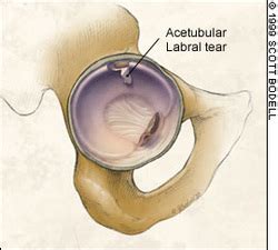 Aching In Back Hips And Knees Sore Hips In Second Trimester Miscarriage Acetabular Labral